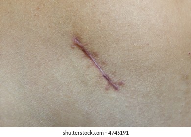 Scar After Appendix Remove Operation