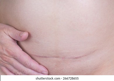 Scar After A Caesarean Section, Bikini Line