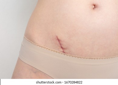 Scar From A Appendix, Closeup. Healthcare Concept