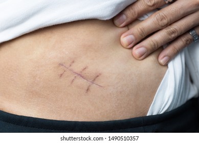 Scar Of Appendix Pain And Appendicitis Inflammation Disease Close Up 