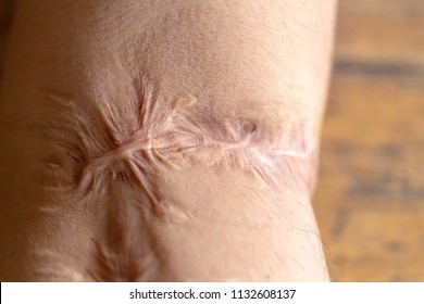 A scar is an area of fibrous tissue that replaces normal skin after an injury on skin arm.