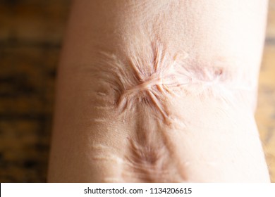A scar is an area of fibrous tissue that replaces normal skin after an injury on skin arm.