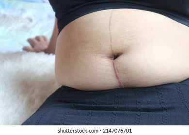 Scar Of Caesarean Section Three Years After Surgery.