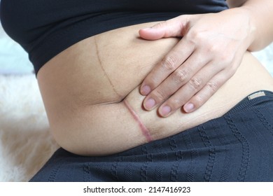 Scar Of Caesarean Section Three Years After Surgery.