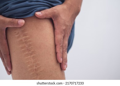 Scar Caused By Leg Surgery