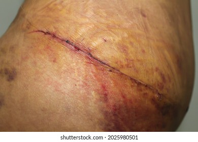 Scar From Closed Stitches Shown On The Hip Of A Patient After Doing A Tummy Tuck Revision. Cosmetic Surgery Or Plastic Surgery Procedure. Bruising Is Shown On The Body.