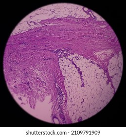 Scar endometriosis, microscopic image show fibrocollagenous tissue, ingrowth of endometrial glands and stroma, It is rare disease, 40x view.