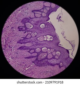 Scar endometriosis, microscopic image show fibrocollagenous tissue, ingrowth of endometrial glands and stroma, It is rare disease, 40x view.