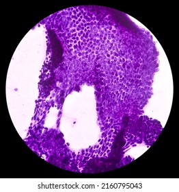 Scar endometriosis(FNA), microscopic image show benign epithelial cells and stromal cells, background show polymorphs, lymphocytes, histiocytes, blood, It is rare disease.