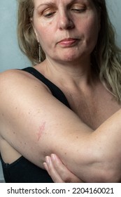 Scar Following Surgery For Removal Of Malignant Melanoma Skin Cancer Mole On A Mature Woman 