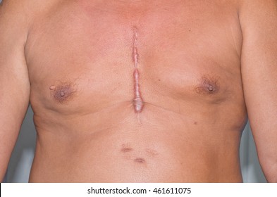 Scar From Heart Surgery