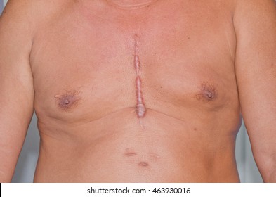 Scar From Heart Surgery