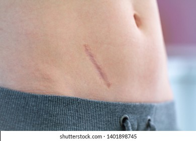 Scar on the abdomen after removal of appendicitis and abdominal surgery. Body scars close up 