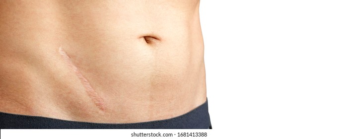 Scar on abdomen after removal of appendicitis. Banner with copy space