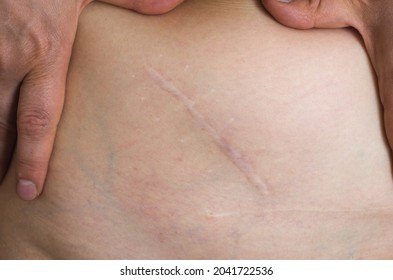 
scar on the abdomen after surgery to remove appendicitis after a year or more, healed the scar
