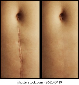 Scar After Surgery Images Stock Photos Vectors Shutterstock