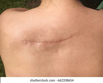 Scar On The Back, A Benign Tumor Removed