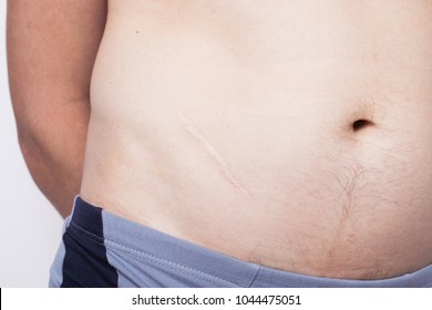 scar on the body after appendicitis. body parts: navel and belly close up