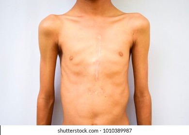 Scar On The Chest And Surgery Of A Thin Boy With Heart Disease.