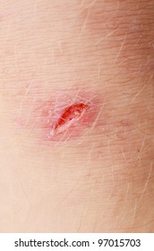 scar on human skin stock photo 97015703 cut skin images stock photos vectors scar on human skin stock photo 97015703 cut skin images stock photos vectors
