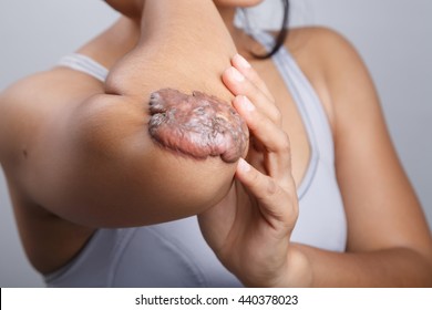 Scar On Human Skin, Keloid On Elbow