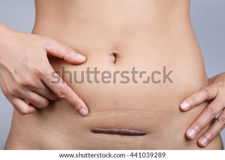 scar on human skin stock photo 121658896 scar on human skin keloid hysterectomy stockfoto jetzt scar on human skin stock photo 121658896 scar on human skin keloid hysterectomy stockfoto jetzt