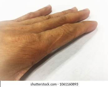 Scar On The Index Finger Of Left-hand Cause From Knife Is Cut.