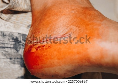 A scar on the leg after a foot replacement operation. Broken leg bone. Close up. Pain, trauma, wound treatment