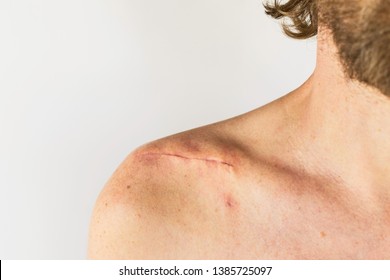 Scar On The Of A Male Body After Surgery On A Broken Collarbone, Acromion And Shoulder