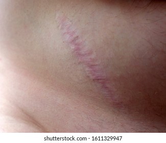 scar on a man's body from appendicitis surgery