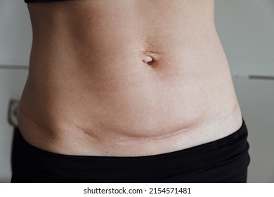Scar on the skin. Abdomen of woman after the child birth by Cesarean section. Stretch marks after pregnancy. Navel hernia. White line diastasis. Close-up. Lymph flow violation and fluid stagnation.