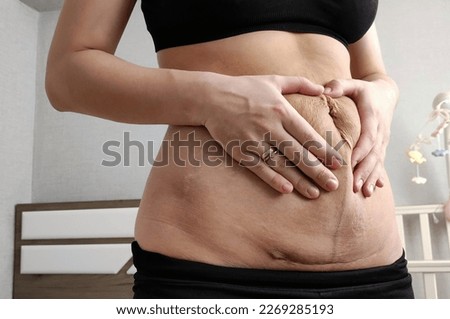 Scar on a woman belly from a caesarean section. Hands touching the skin. Deposition of the abdomen fat. Body after pregnancy. Stretch marks and overweight.