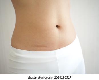 Scar on woman's abdomen after appendicitis removal and abdominal surgery. closeup  photo, blurred.