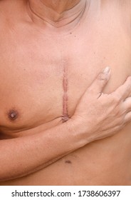 Scar From Open Heart Surgery
