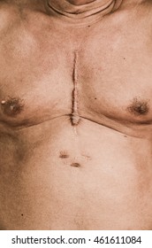 Scar From Open Heart Surgery