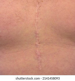 Scar From Open Heart Surgery On White Man, Where The Sternum Was Cut In Two, And The Rib Cage Sprung.