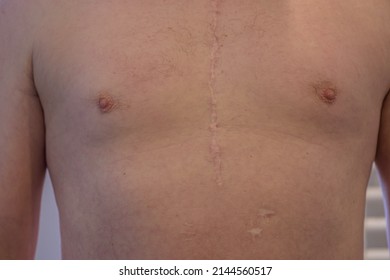 Scar From Open Heart Surgery On White Man, Where The Sternum Was Cut In Two, And The Rib Cage Sprung.
