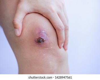 Scar And Scab (eschar) On Asian Female Knee