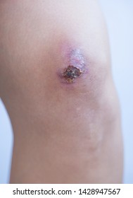 Scar And Scab (eschar) On Asian Female Knee