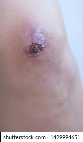 Scar And Scab (eschar) On Asian Female Knee