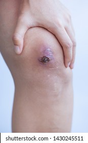 Scar And Scab (eschar) On Asian Female Knee