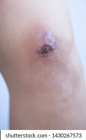 Scar And Scab (eschar) On Asian Female Knee