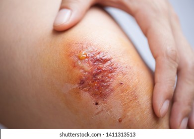 Scar And Scab (eschar) On The Knee