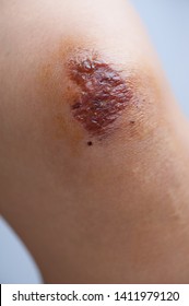 Scar And Scab (eschar) On The Knee