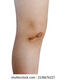 Scar And Scab (eschar) On The Knee