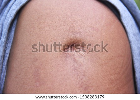 Scar skin from a bullet hole on asian men's shoulder