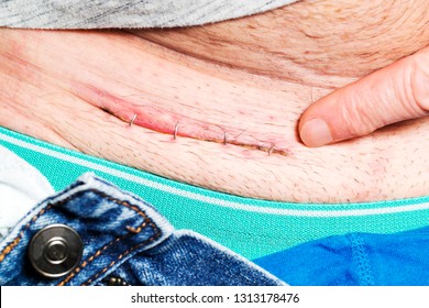 Scar With Staples In Groin Of Body  By Operation Of A Hernia , Close Up