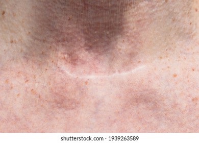 Scar From Thyroid Removal Surgery Due To Cancer. Conservative Method Of Surgery. Close Up.