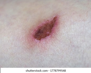 Scar Tissue Following Abrasion Graze On Stock Photo 1778799548 ...