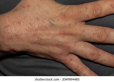 Scarlet Fever In An Adult Caucasian Man